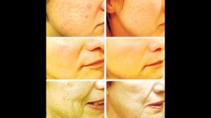 Жёлтый пилинг (ретиноловый пилинг)