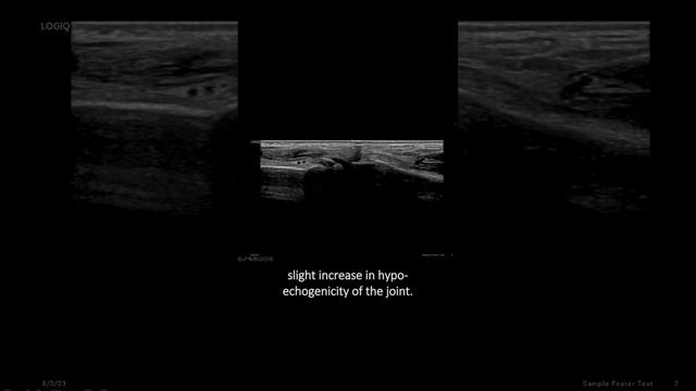 #ultrasound Guided Interventions: Cases (Avulsion Injury) #fyp #sports #sportsmedicine #sport смотреть онлайн