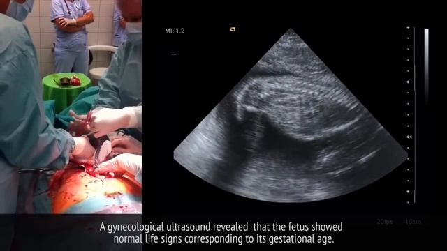 Шок!!'Женщина родила после смерти! 720 (Интересное видео) смотреть онлайн