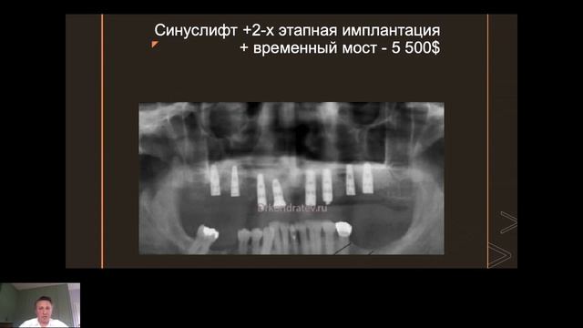 Антикризисная одноэтапная имплантация - оптимальный выбор в условиях снижения доходов населения! смотреть онлайн