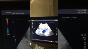 Второй скрининг 16 -17 недель