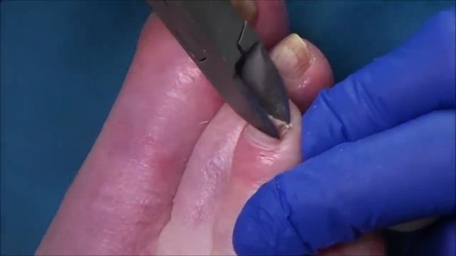Simple Toenail Cutting in Podiatry Office, Chemotherapy and Neuropathy смотреть онлайн