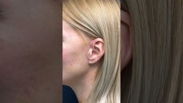 Подтяжка лица в 50лет смотреть онлайн