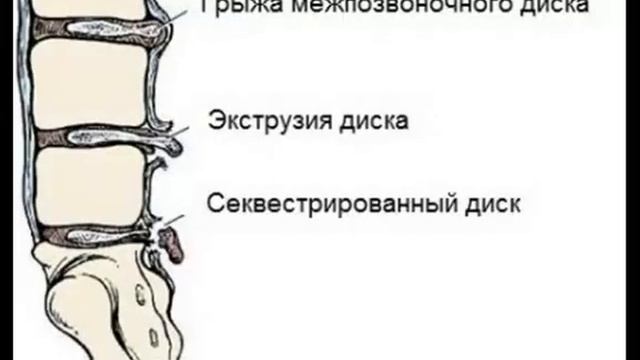 Экструзия межпозвонкового диска смотреть онлайн
