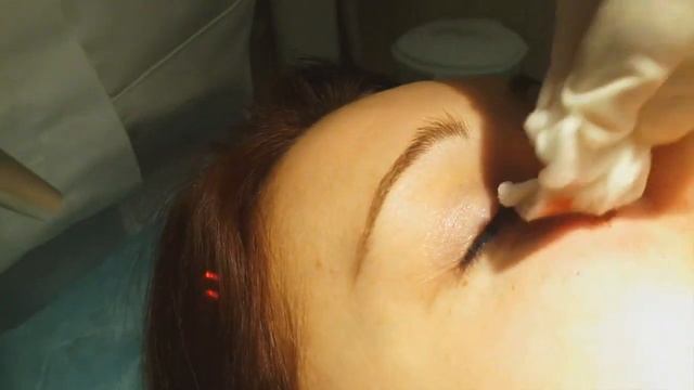 Удаление родинки лазером смотреть онлайн