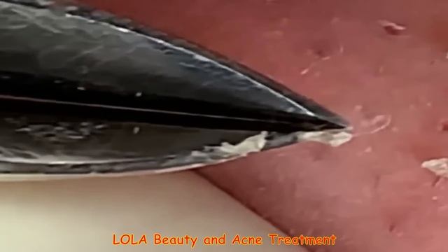 Enjoy Plucking Those Whiteheads with a Tweezer смотреть онлайн