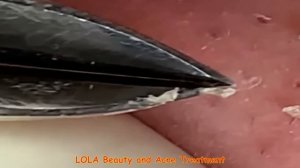 Enjoy Plucking Those Whiteheads with a Tweezer