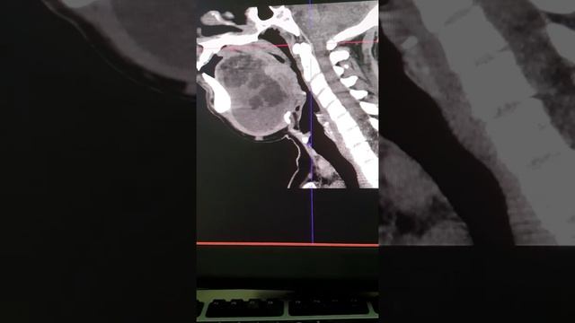 Кт шеи! Киста шеи ! Киста под языком! Срелинная киста шеи ! смотреть онлайн