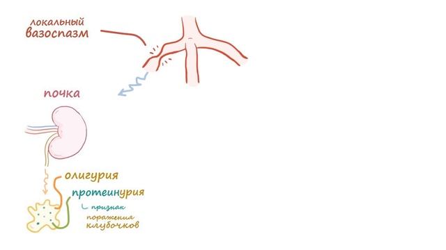 Преэклампсия и Эклампсия - причины, симптомы (Osmosis) смотреть онлайн