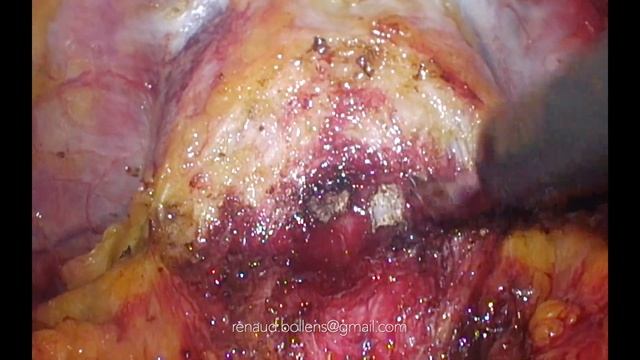 Pudendal neurolysis, extended pelvic lymph node dissection and radical prostatectomy смотреть онлайн