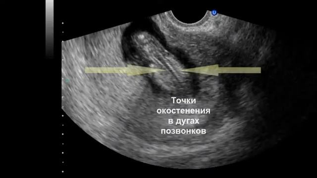 Ультразвуковая анатомия плода в I триместре беременности смотреть онлайн