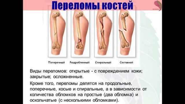 ▼Переломы Конечностей▼|▼Perelomy Konechnostej▼ смотреть онлайн