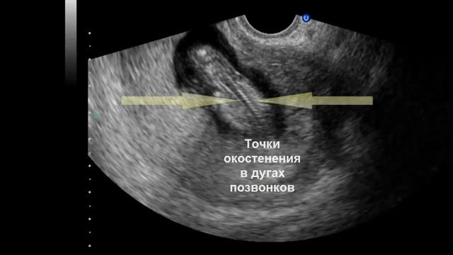 7 Ультразвуковая анатомия плода в I триместре беременности.mp4 смотреть онлайн