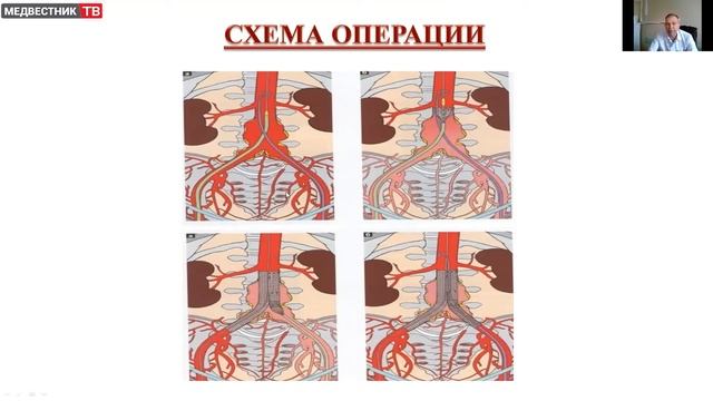 Школа клинициста: Хирургическое лечение аневризм брюшной аорты смотреть онлайн