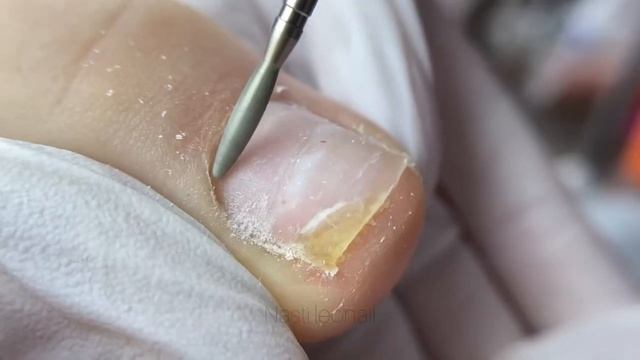 Толстое покрытие / Педикюр / Гельлак / Отслойка гельлака / Трещина ногтя смотреть онлайн