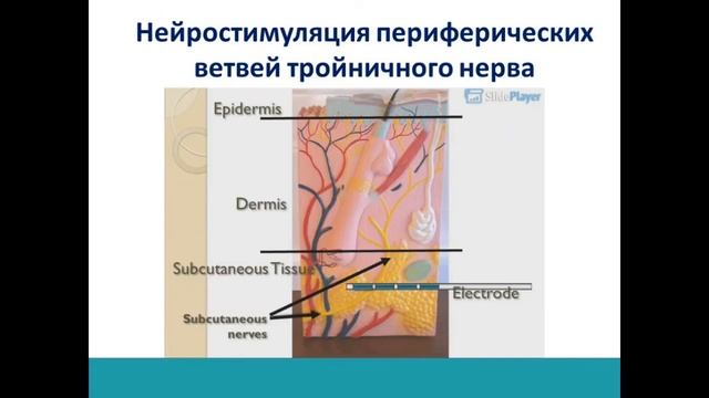 Лицевые боли Часть 2 Хирургия лицевых болей. смотреть онлайн