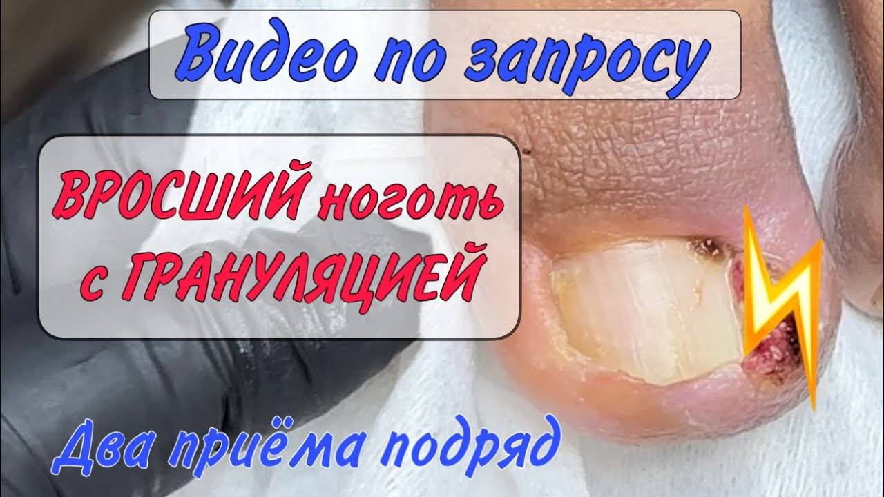 ⚡️Вросший ноготь _ дикое Мясо _ Гипергрануляция смотреть онлайн