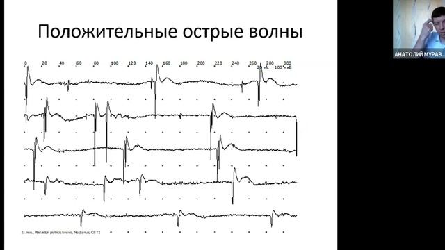 Игольчатая электромиография (ЭМГ) | Вебинар Нейрософт