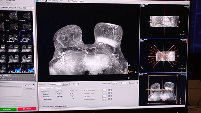 MRI Breast Dynamic Post Processing And Filming On Philips 3T