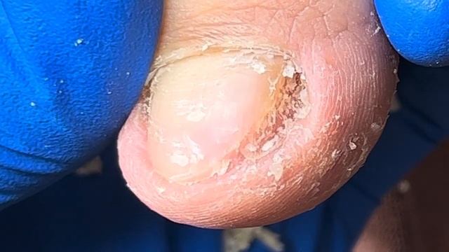 A large nail deep in the toenail, dig it out little by little!【Xue Yidao】 смотреть онлайн