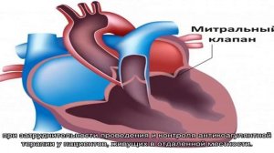 Протезирование митрального клапана