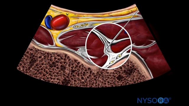Hip Block - NYSORA's Reverse Ultrasound™ Animation