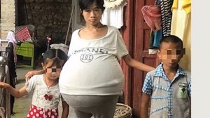 Живот женщины раздулся до аномальных размеров из за загадочной болезни!