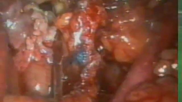 Sentinel Lymph Node and endometrial cancer.mpg смотреть онлайн