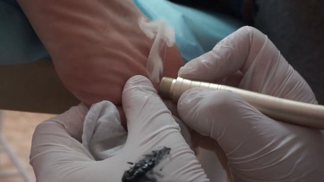 Удаление Мозоли На Стопе Диодным Лазером смотреть онлайн