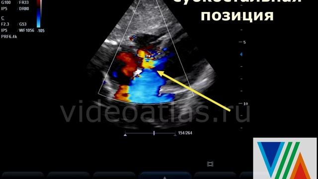 Субаортальный ДМЖП смотреть онлайн