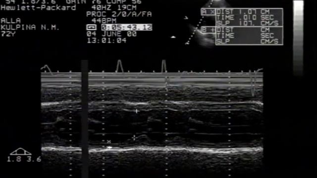 Митральная недостаточность. Эхокардиография ©Mitral Insufficiency. Echocardiography