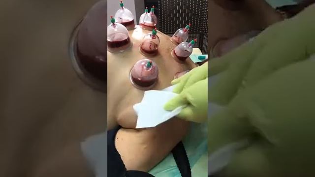 Что такое Хиджама??? Процесс. смотреть онлайн