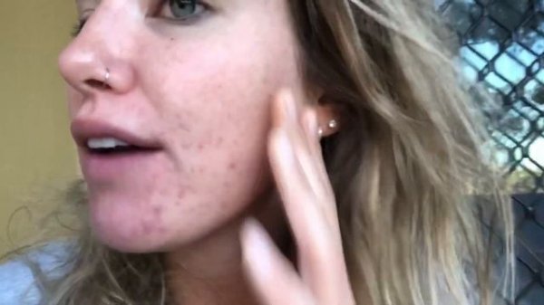 DOXYCYCLINE 4-12 weeks of treatment! Acne update!