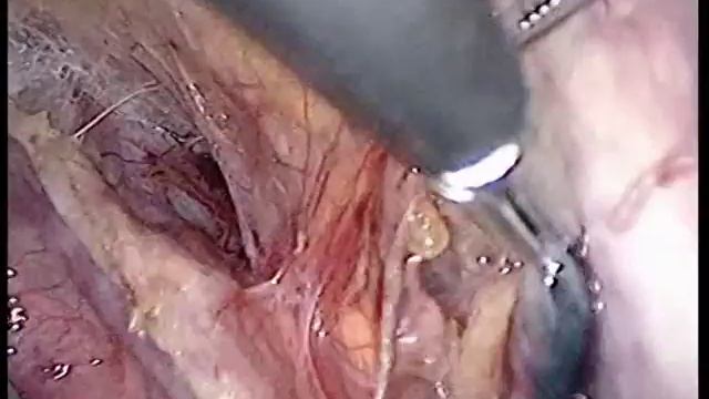 Laparoscopic Pelvic Sentinel Lymph Node Biopsy смотреть онлайн