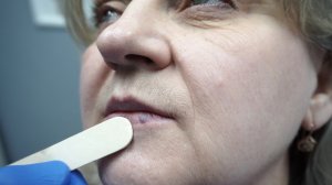 Удаление Ангиомы На Нижней Губе