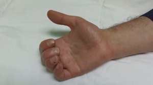 Функция через 3,5 месяца после пластики сухожилия глубокого сгибателя 4 пальца левой кисти.