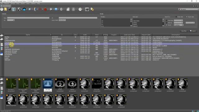 OsiriX on Windows: Coronary ArteryAnalysis #Acton #OsiriXIndia #AHEIPL #OfficialOsiriXIndianReselle смотреть онлайн