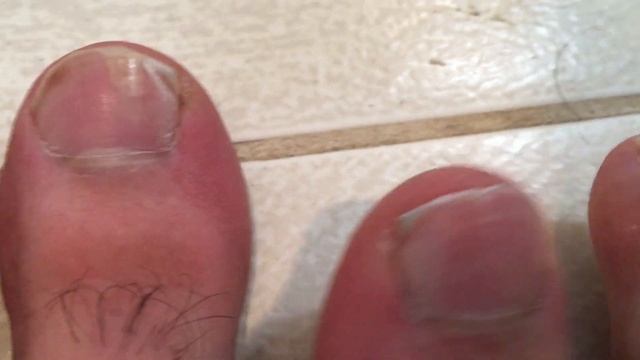 Как обрезать ноготь на ноге чтобы не врастал
