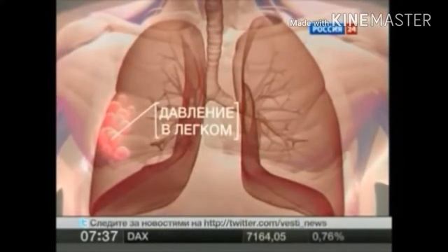 Эмфизема заболевание дыхательных путей русская озвучка смотреть онлайн