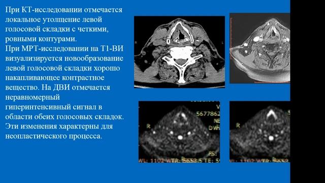 Припорова Ю.Н. «Высокотехнологичные методы лучевой диагностики патологий гортани» смотреть онлайн