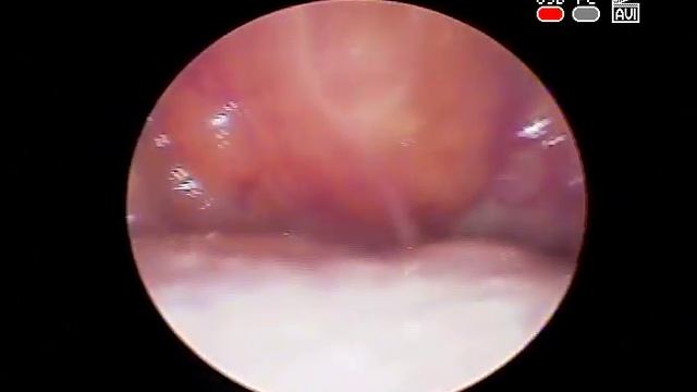 #Tonsil #Stone Тонзиллит Камни #Миндалин Лечение ЛОР врач КЛИНИКА ОБРАЗЦОВА