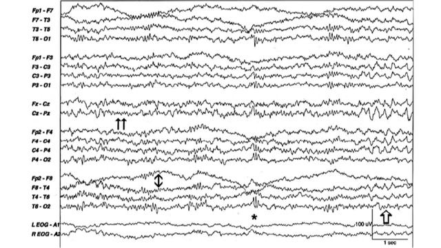 ЭЭГ сна. Часть 1 смотреть онлайн