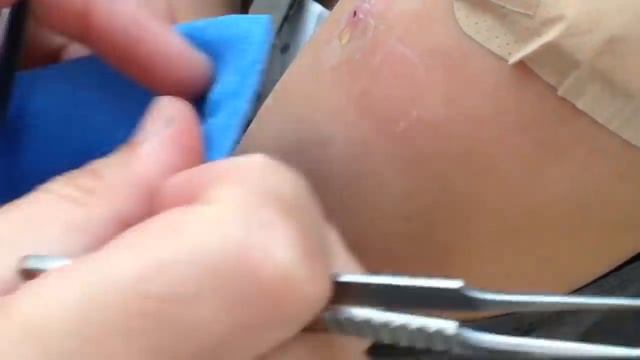 Removing botfly larvae from under human skin смотреть онлайн