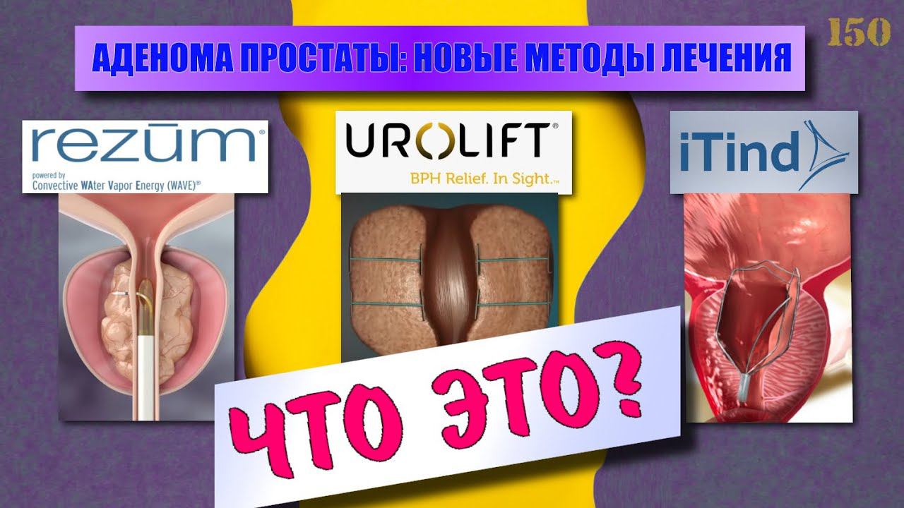 Аденома простаты - новые малоинвазивные методы лечения смотреть онлайн