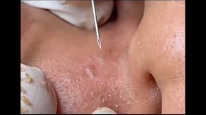 see acne removal!№24 ВЫДАВЛИВАНИЕ ПРЫЩЕЙ!
