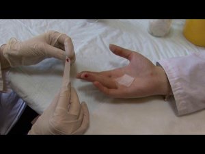 определение времени кровотечения по Дюку