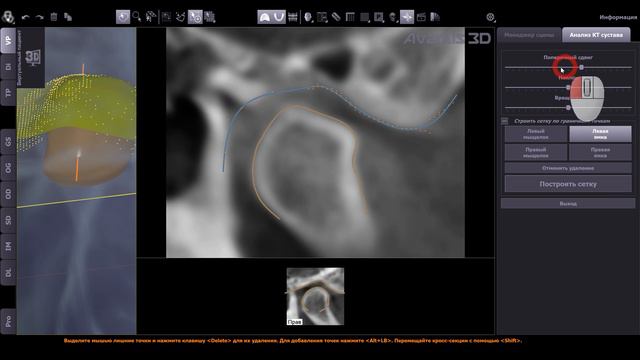 Выделение ВНЧС. Новые возможности Avantis 3D смотреть онлайн