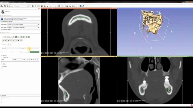 3D Slicer Tutorial смотреть онлайн
