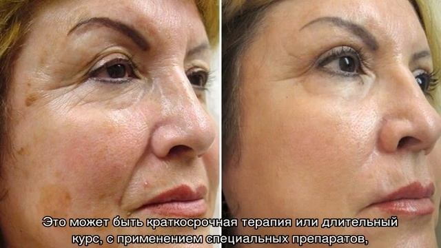 Сухие пятна на коже смотреть онлайн