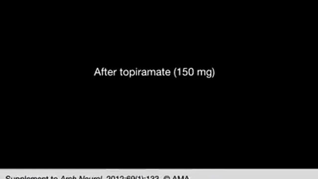 Topiramate Effect in Opsoclonus-Myoclonus-Ataxia Syndrome смотреть онлайн